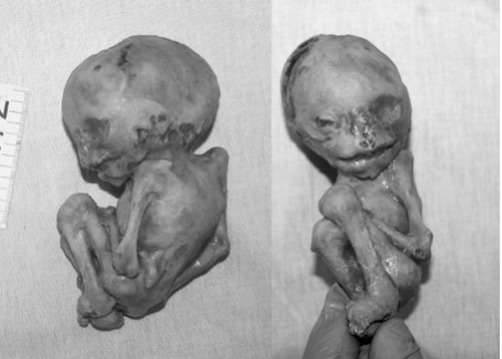 Un fœtus pétrifié découvert dans le ventre d'une femme décédée à ...
