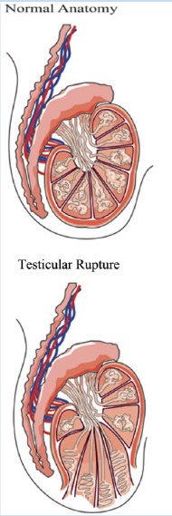 rupture testiculaire – Réalités Biomédicales