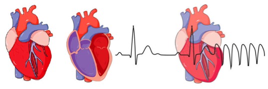 L'arythmie cardiaque – Clinique de soins thérapeutiques