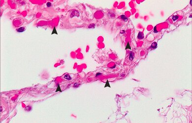 https://asset.lemde.fr/prd-blogs/2020/05/480dfd5f-covid-19-poumon-caillots-thrombi-capillaires-alveolaires-alveoles-coronavirus.jpg