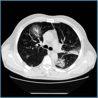 poumons – Réalités Biomédicales