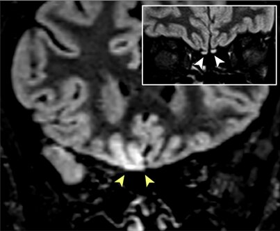 Covid-19 : anomalie du cerveau à l'IRM chez une patiente avec ...