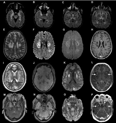 inflammation cérébrale – Réalités Biomédicales