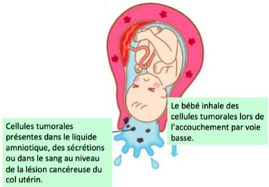 papillomavirus et grossesse accouchement)