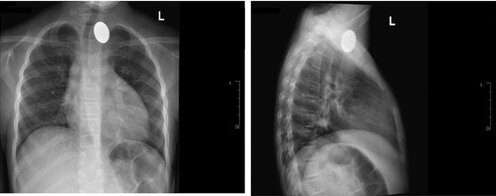 radiographie du thorax – Réalités Biomédicales