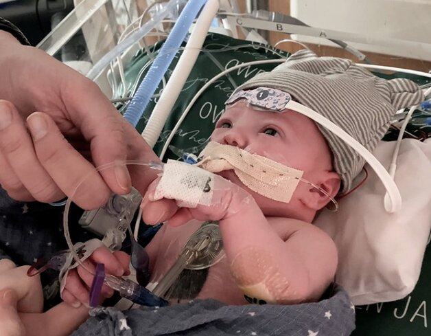 Le premier nouveau-né ayant bénéficié d'une transplantation ...